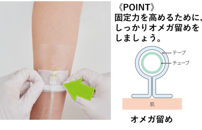 末梢静脈カテーテル固定フィルムのわかりやすい貼り方【エアウォールIV切り込みタイプ】の画像